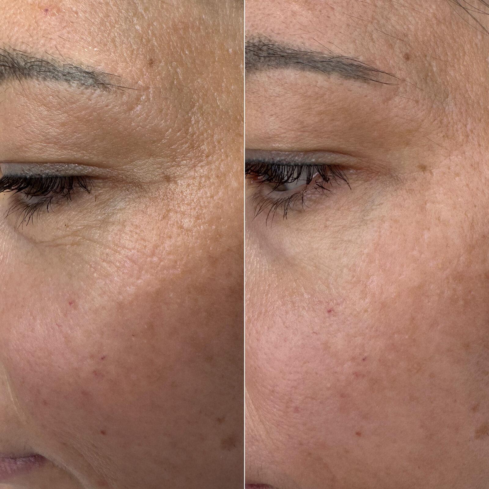 До/після Neocollagen Laser — покращення тону обличчя