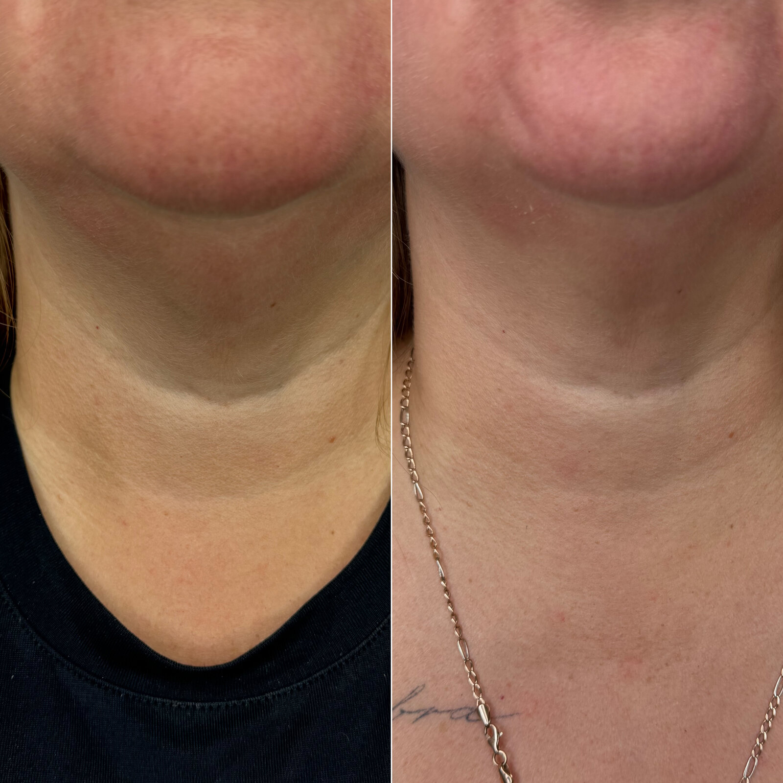 До/після Neocollagen Laser — розгладження зморшок на шиї