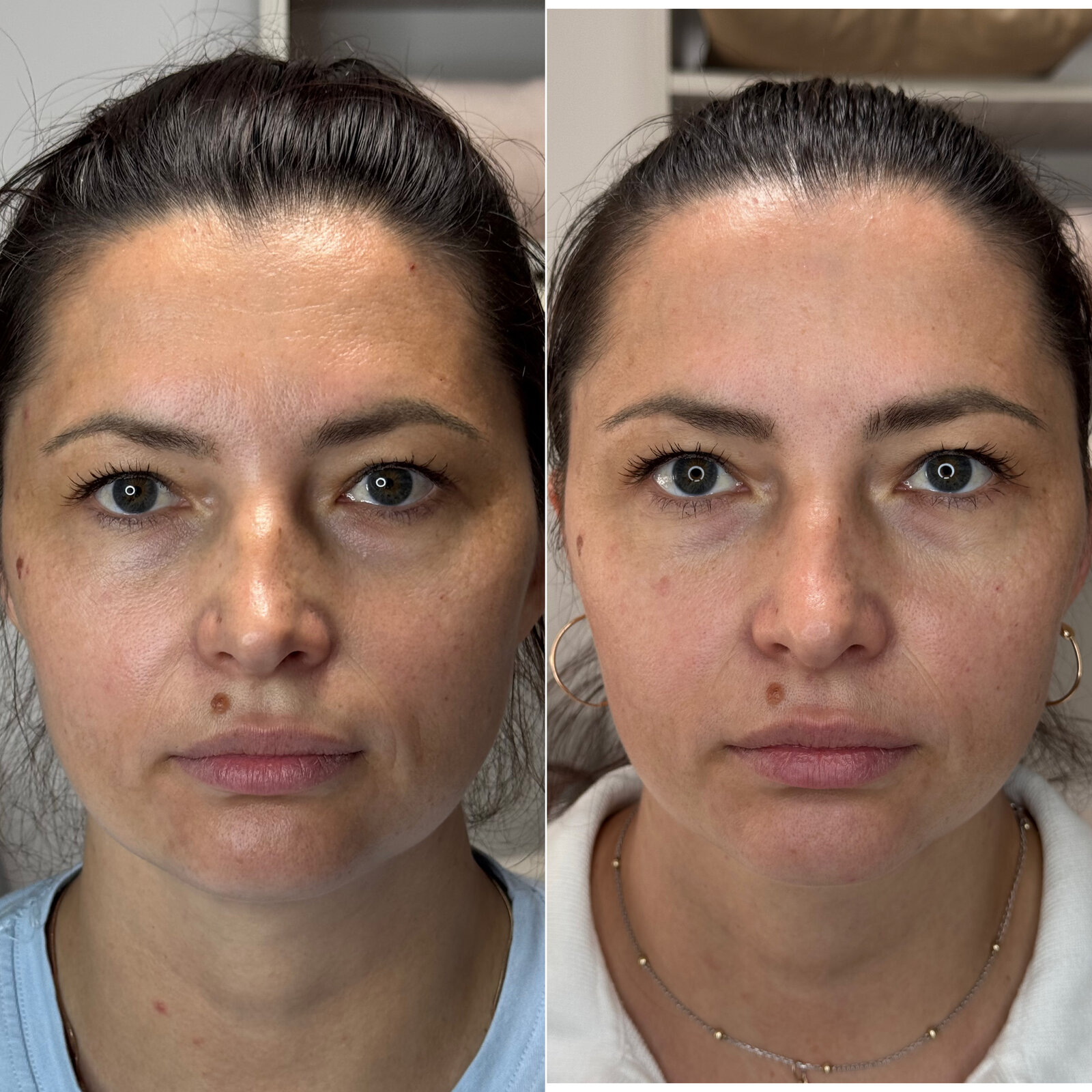До/після Neocollagen Laser — покращення тону обличчя