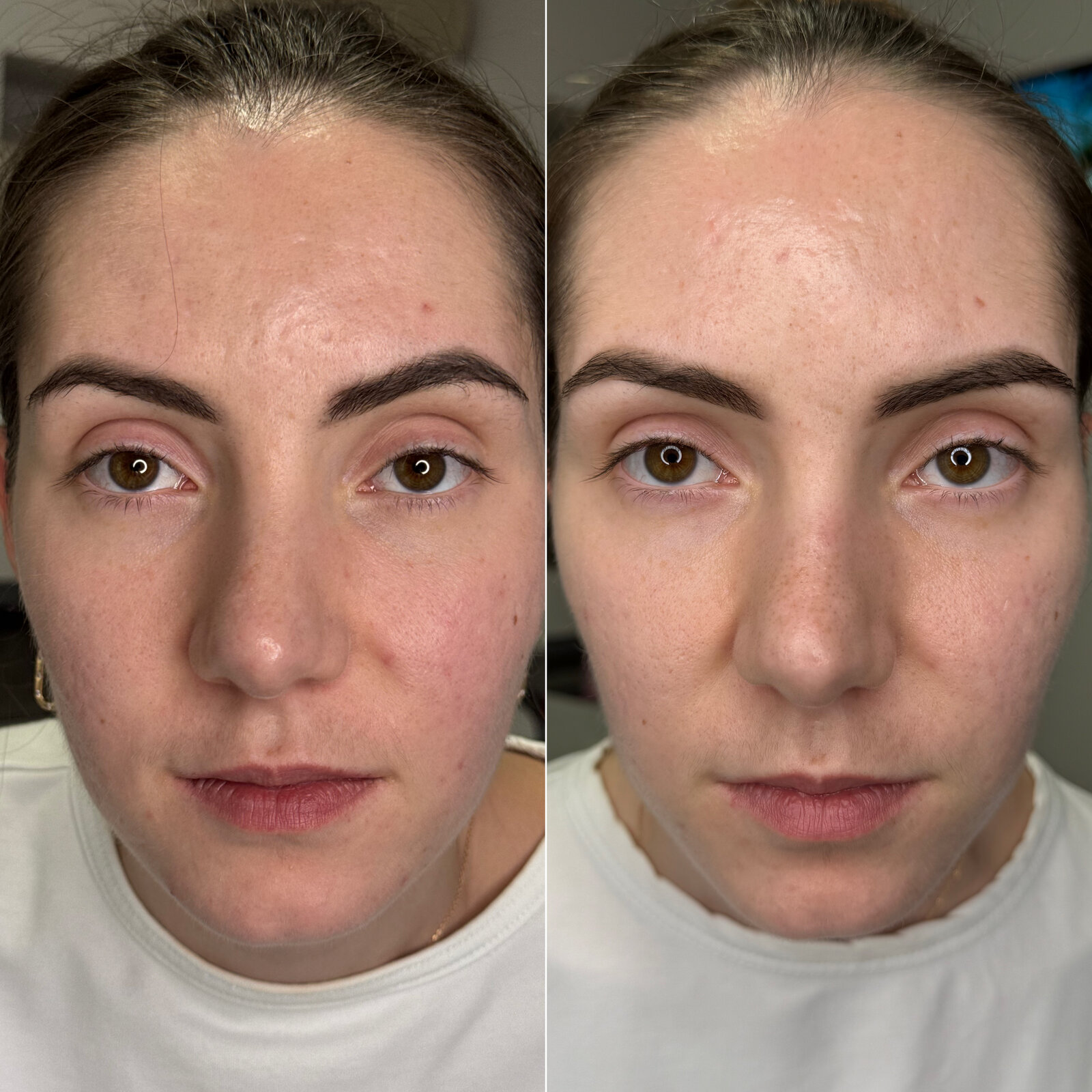 До/після Neocollagen Laser — покращення рельєфу та тону шкіри
