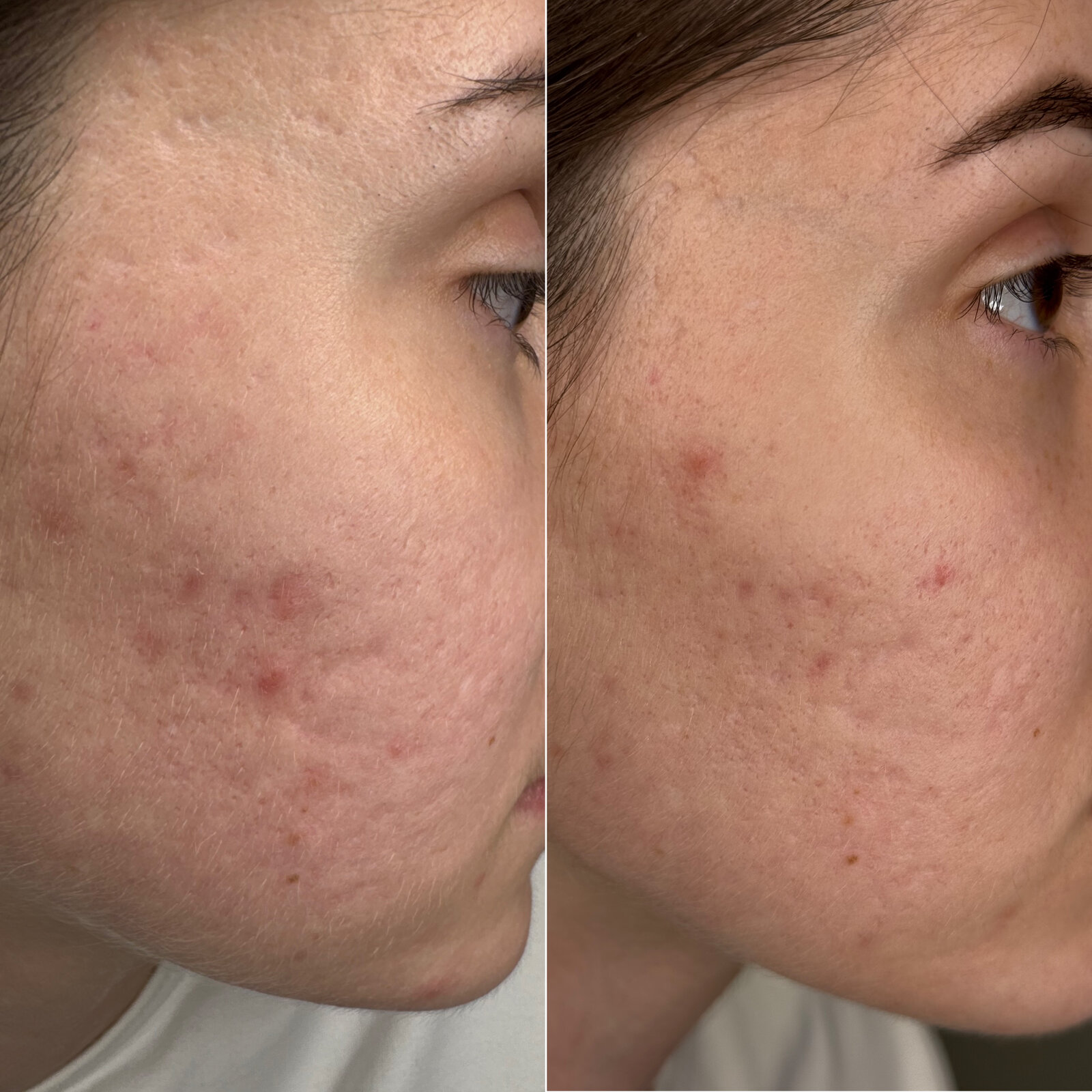 До/після Neocollagen Laser — корекція рубців постакне