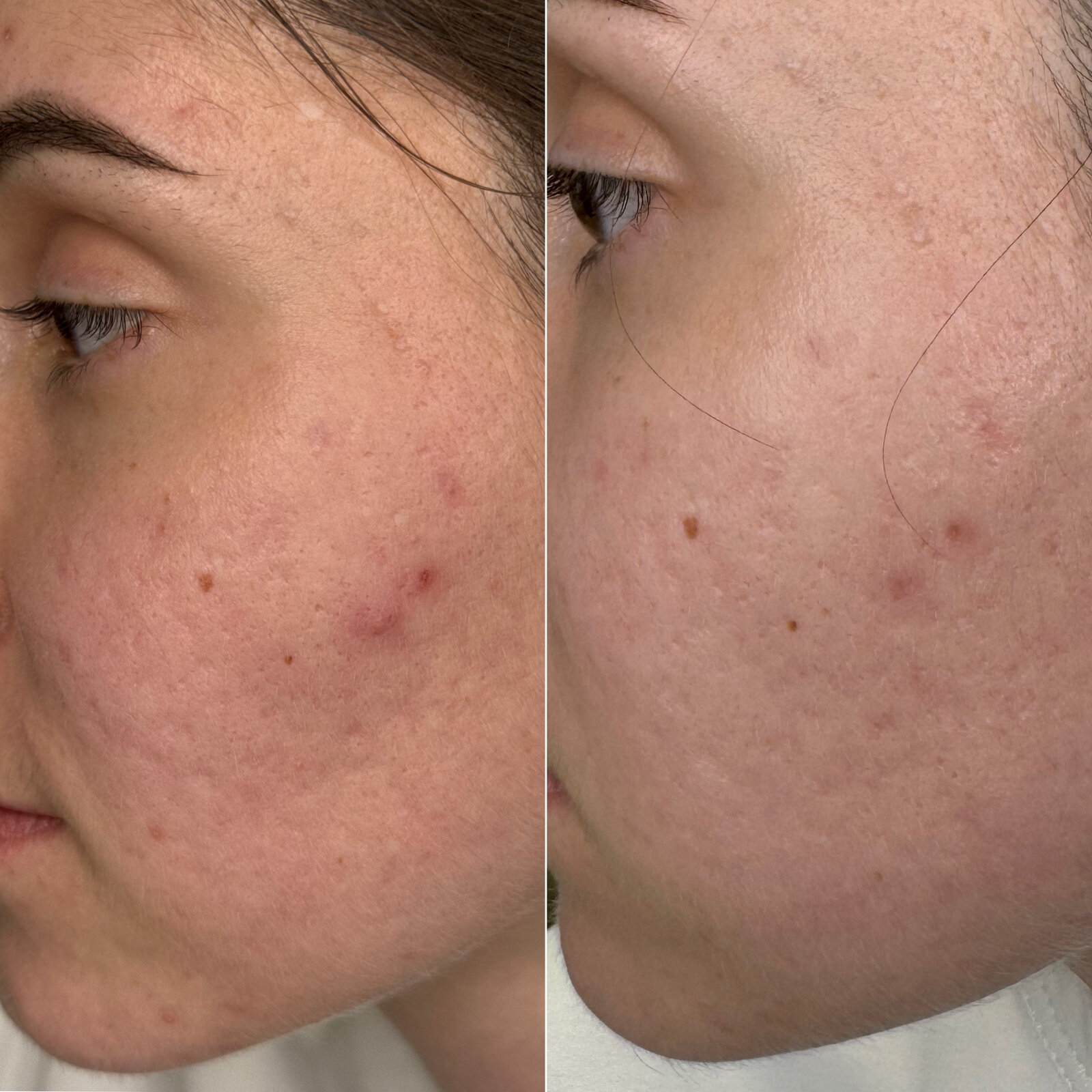 До/після Neocollagen Laser — корекція рубців постакне