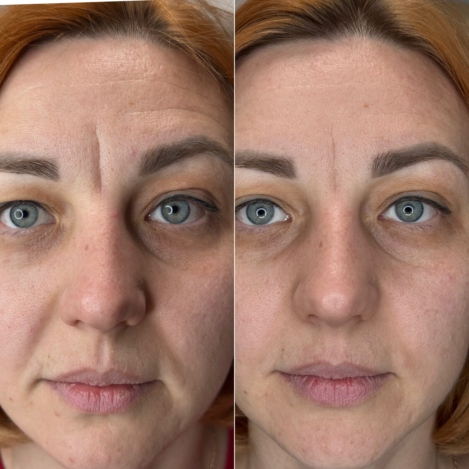 До/після Neocollagen Laser — зменшення глибини зморшок