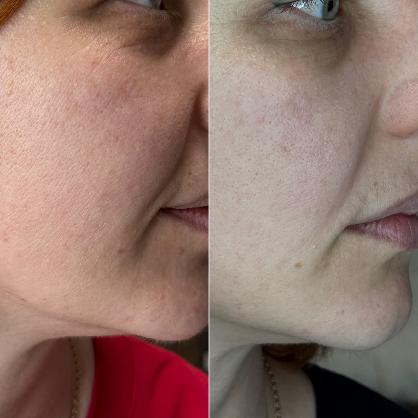 До/після Neocollagen Laser — легкий ліфтинг контуру обличчя