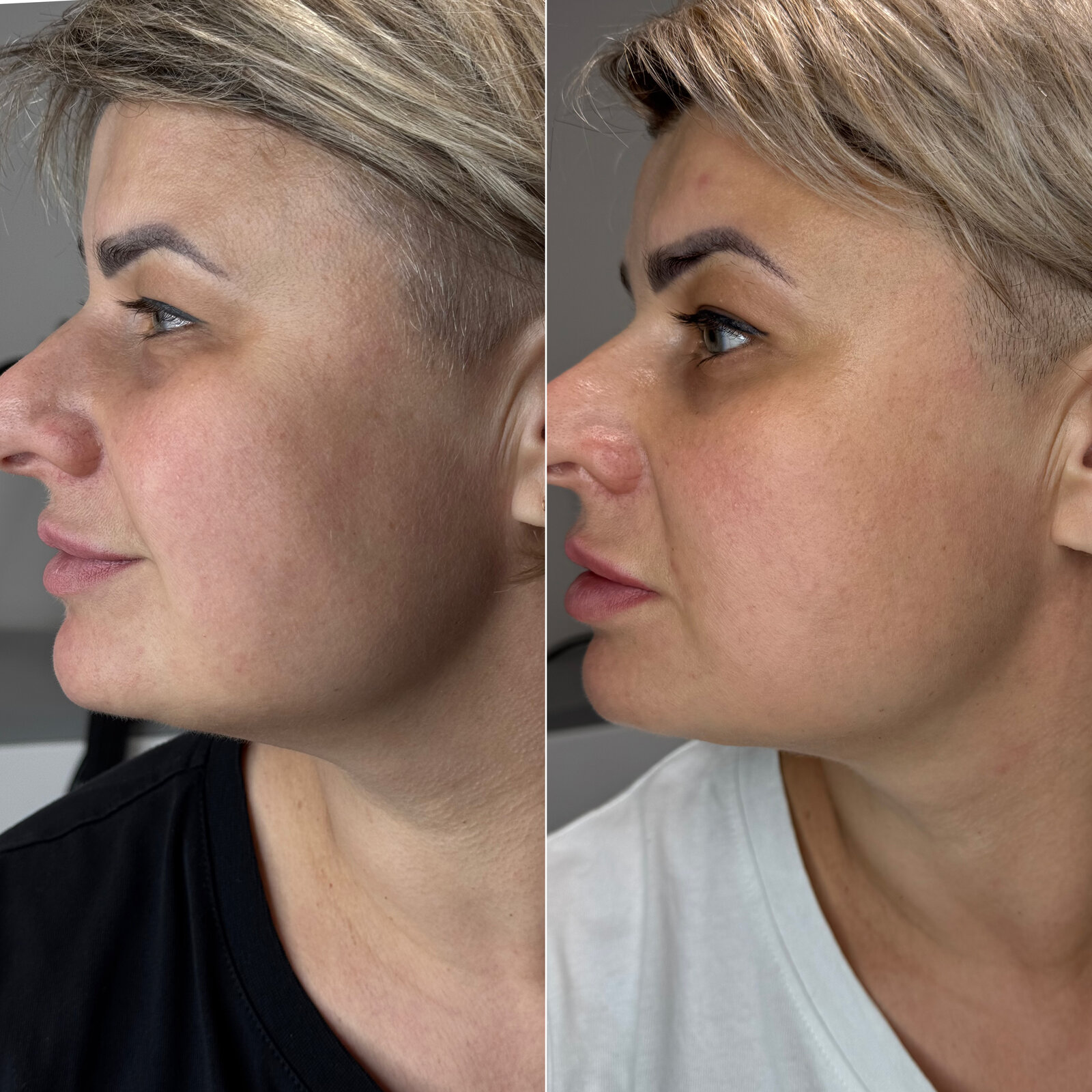 До/після Neocollagen Laser — легкий ліфтинг контуру обличчя
