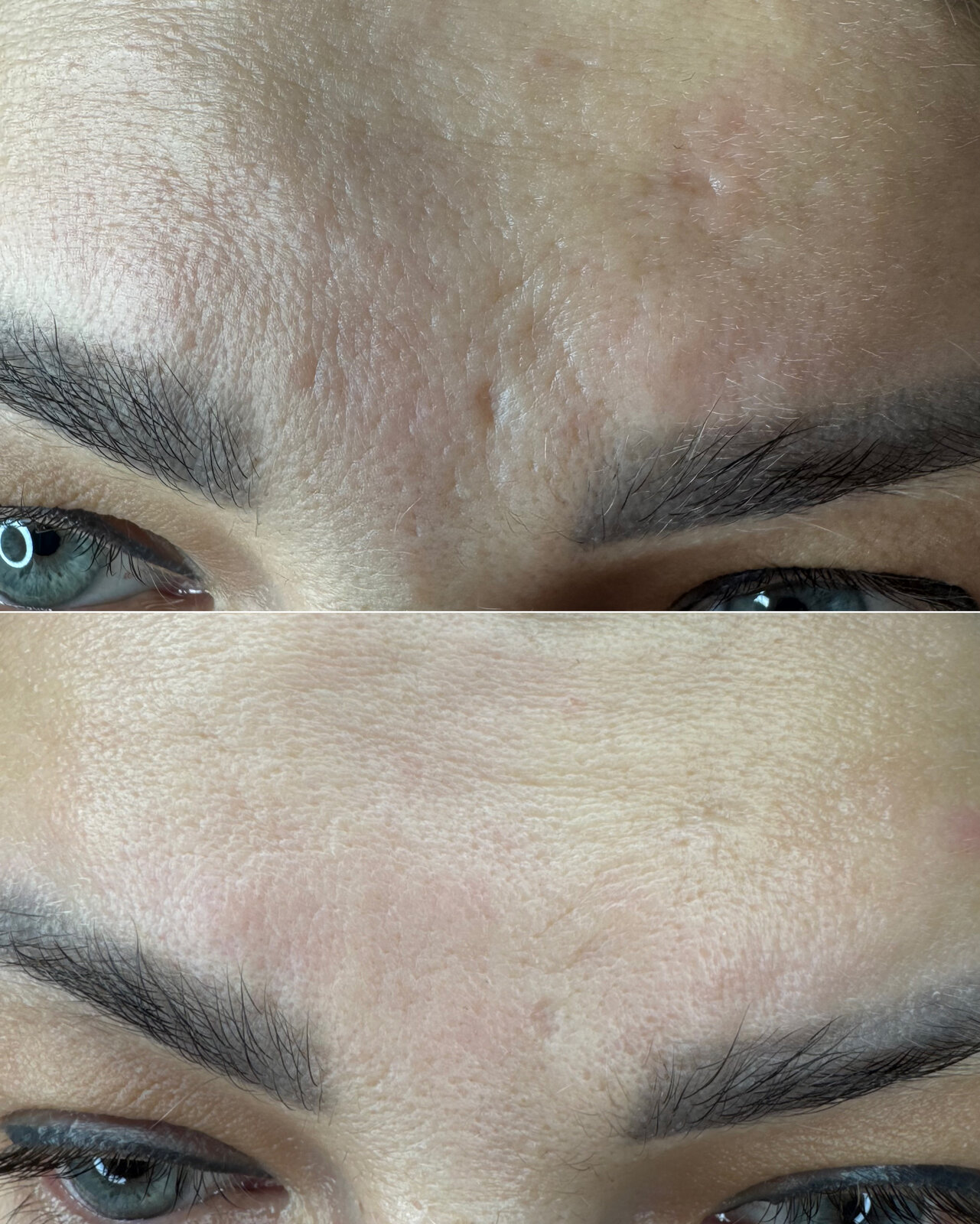 До/після Neocollagen Laser — розгладження зморшок лоба