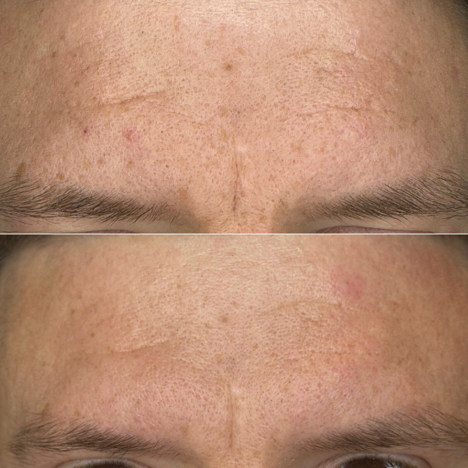 До/після Neocollagen Laser — звуження пор та зменшення глибини зморшок